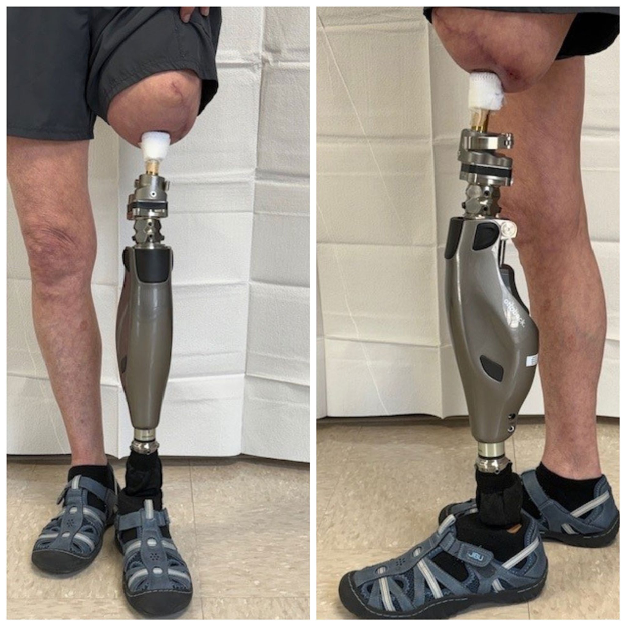 Transfemoral Osseointegration Prosthesis