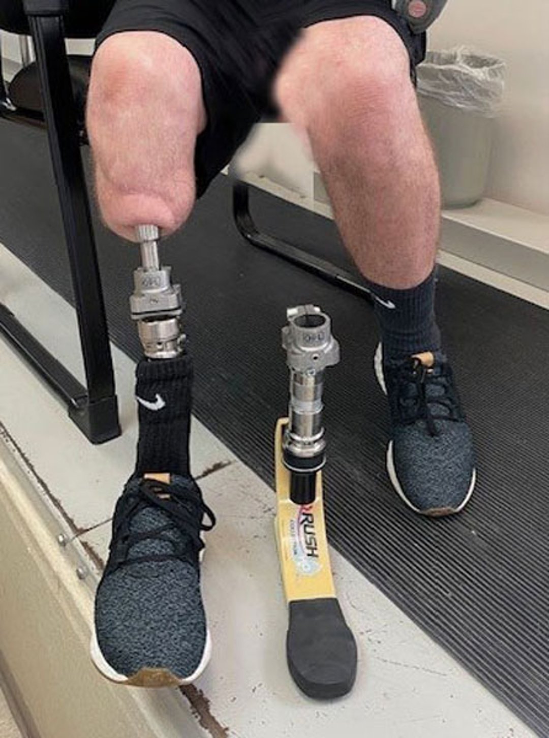 Transtibial Osseointegration Prosthesis