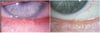 Trichiasis
