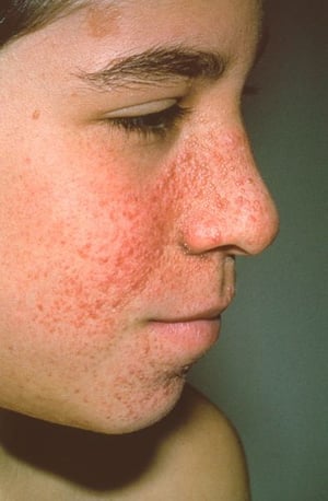 Adenoma Sebaceum in Tuberous Sclerosis Complex