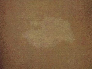 Bintik-bintik Daun Ash pada Kompleks Stuberous Sclerosis