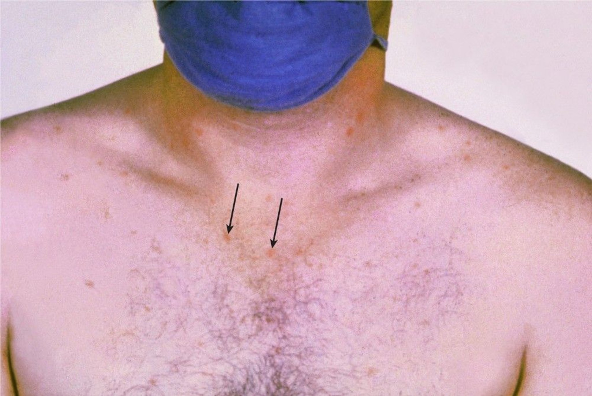 Typhoid Fever (Rose Spots)