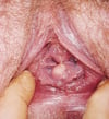 Vaginal Inclusion Cyst