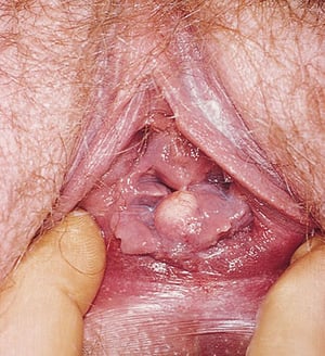 Quiste de inclusión vaginal