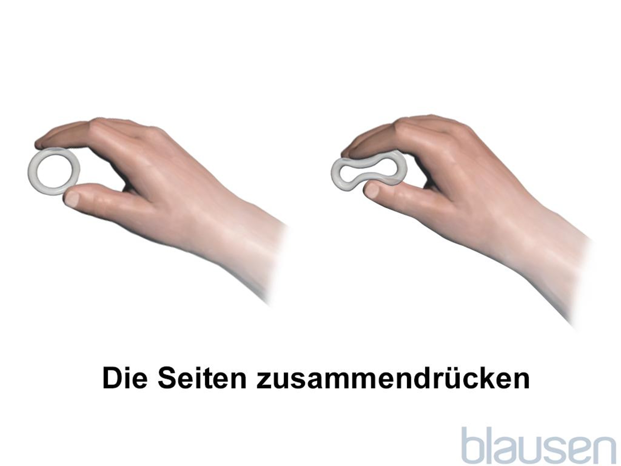 Einführen des Vaginalrings – Schritt 1