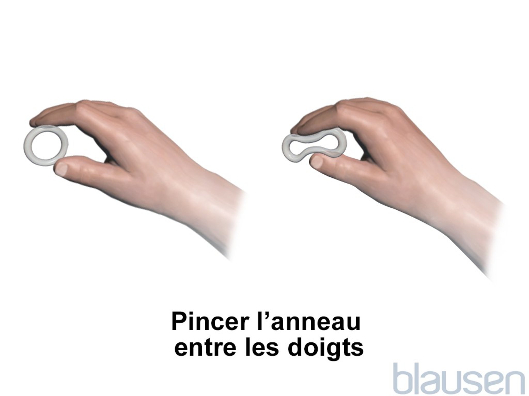 Mise en place d’un anneau vaginal, étape 1