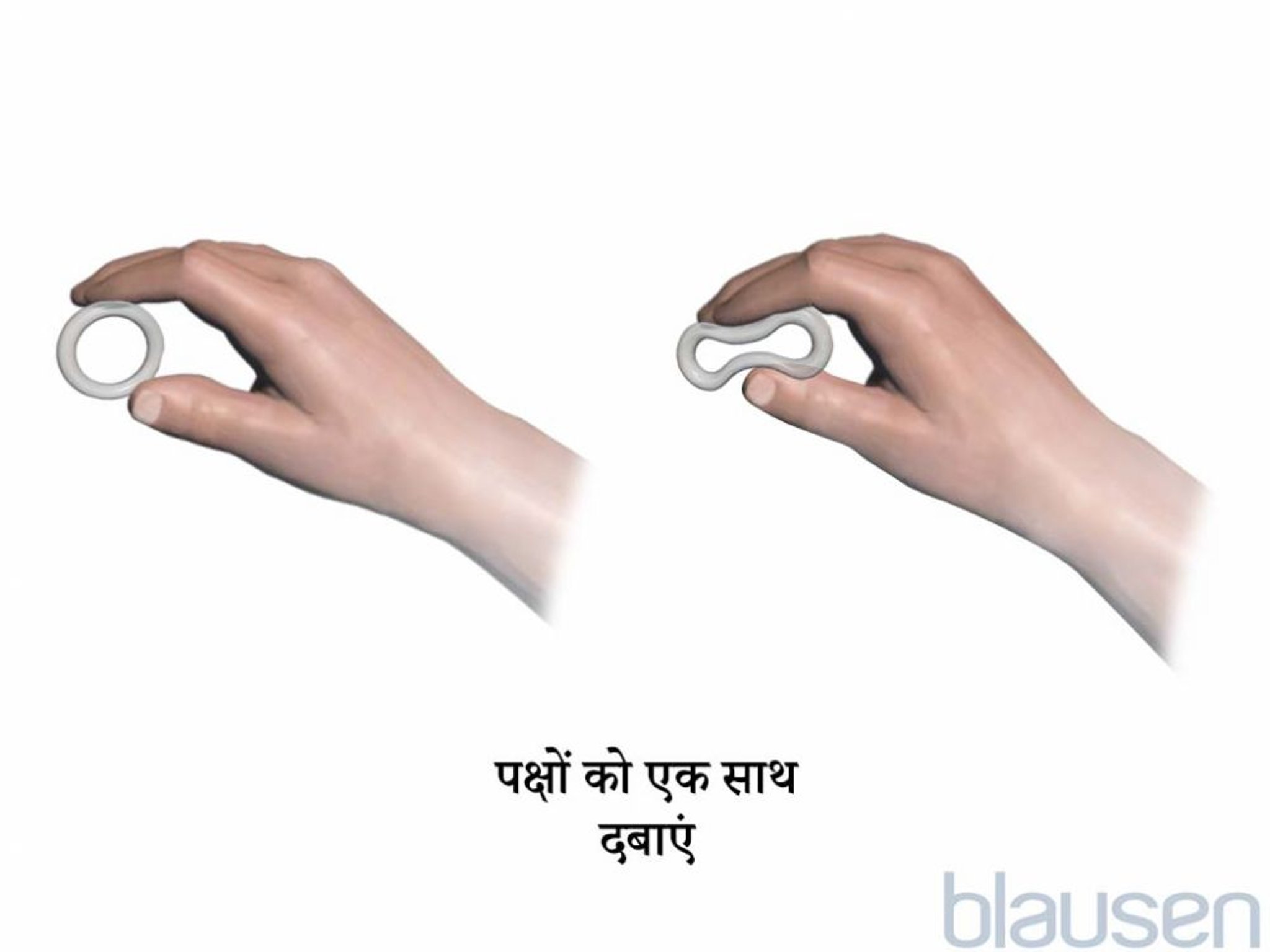 योनि रिंग इस्तेमाल चरण 1