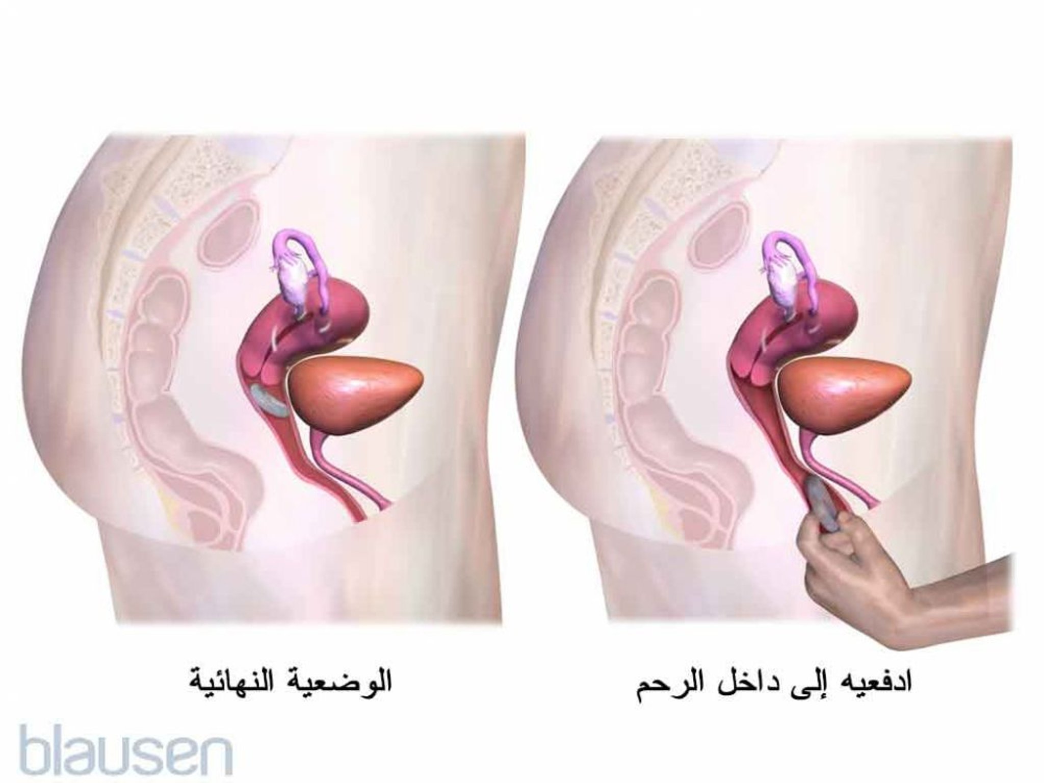 تطبيق الخاتم المهبلي - الخطوة 2