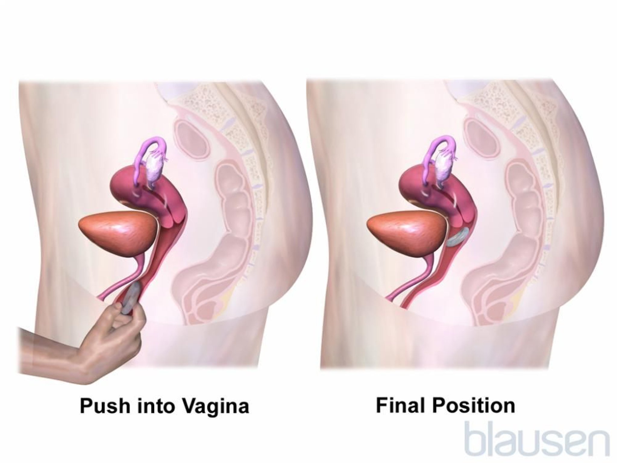 Aplicación del anillo vaginal Paso 2