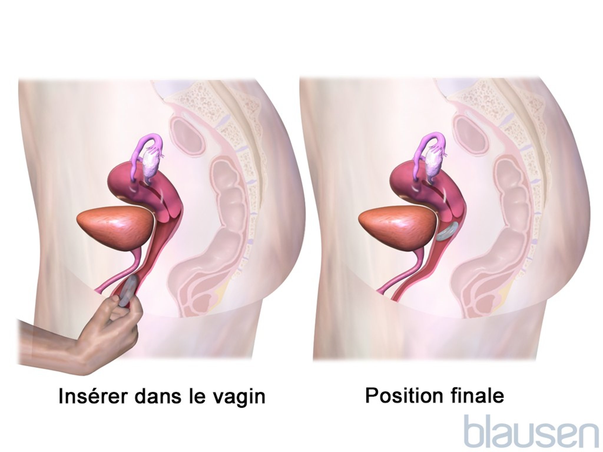 Mise en place d’un anneau vaginal, étape 2