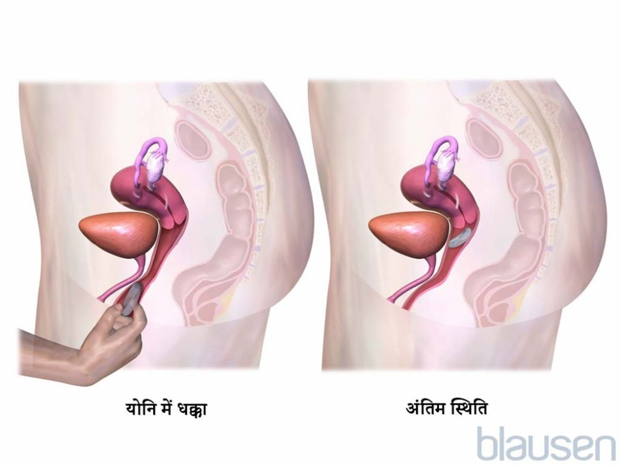 योनि रिंग इस्तेमाल चरण 2
