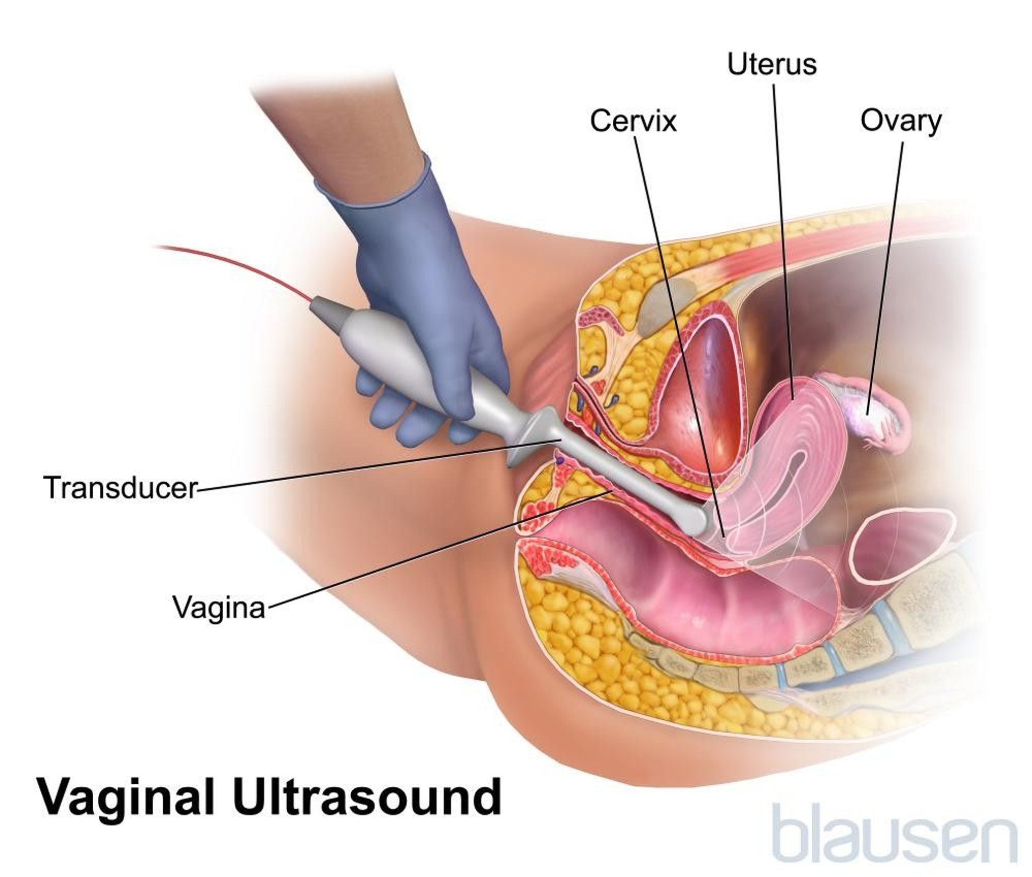 Transvaginal Ultrasonography