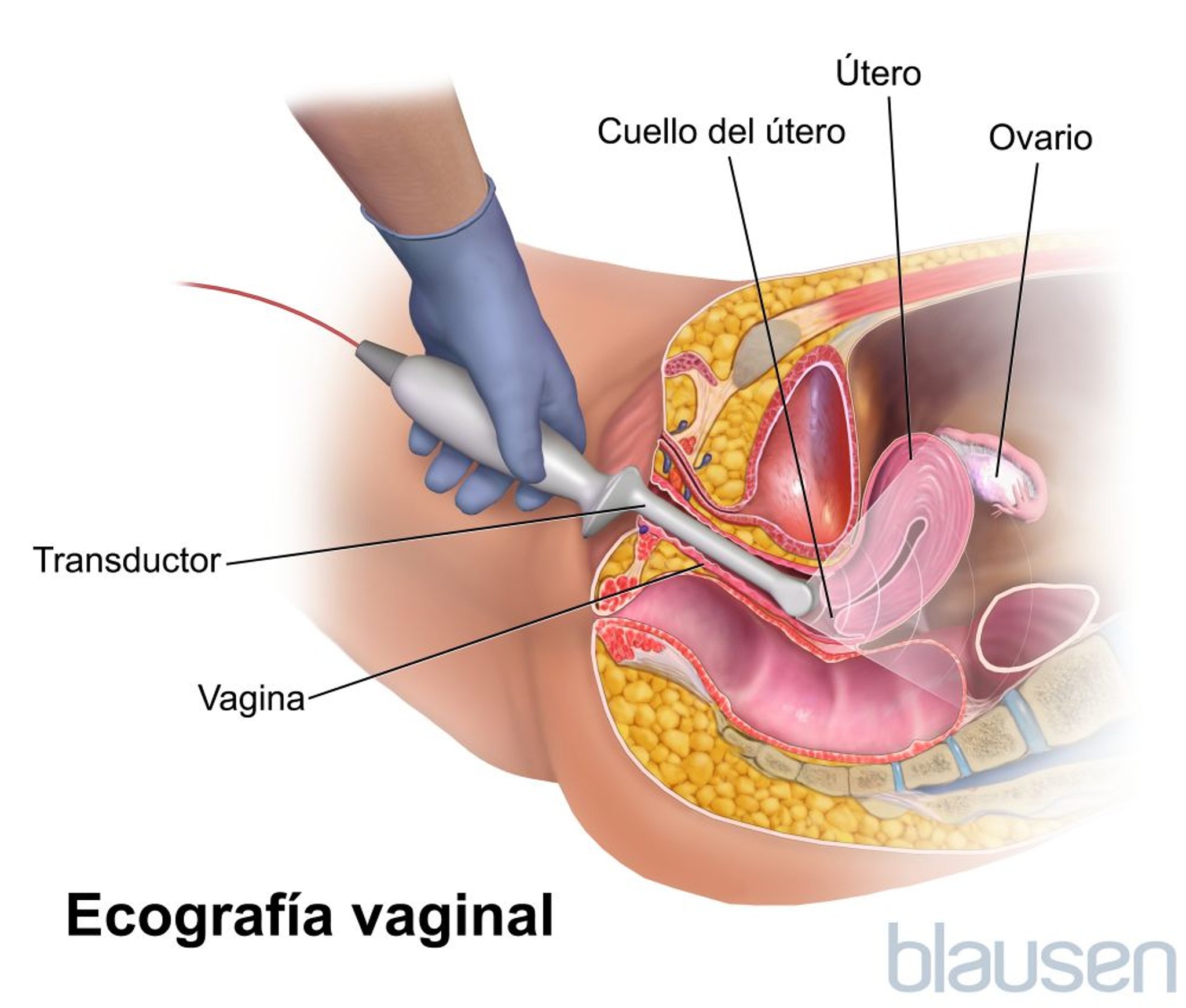 Ecografía transvaginal