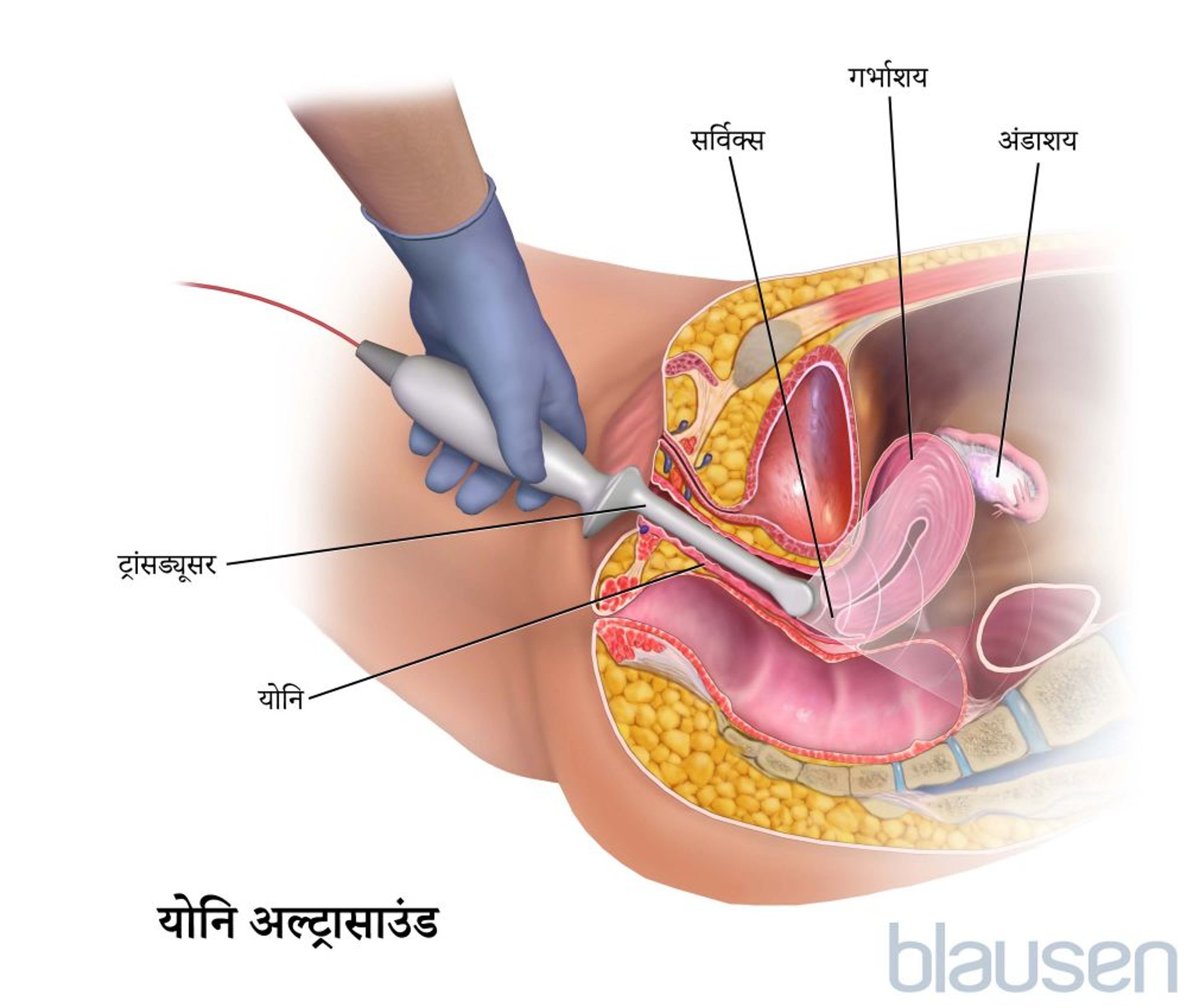 ट्रांसवजाईनल अल्ट्रासोनोग्राफी