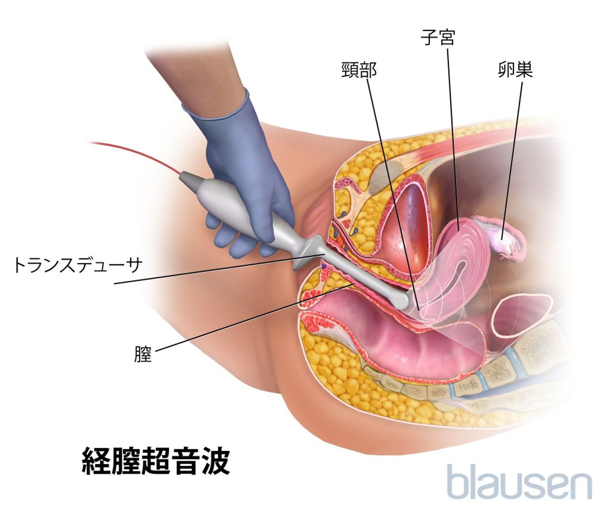 経腟超音波検査