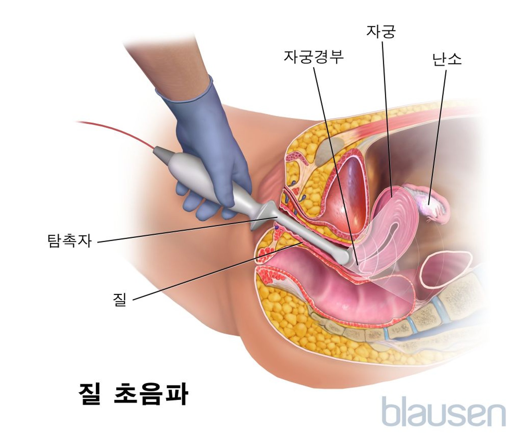 질경유 초음파촬영술