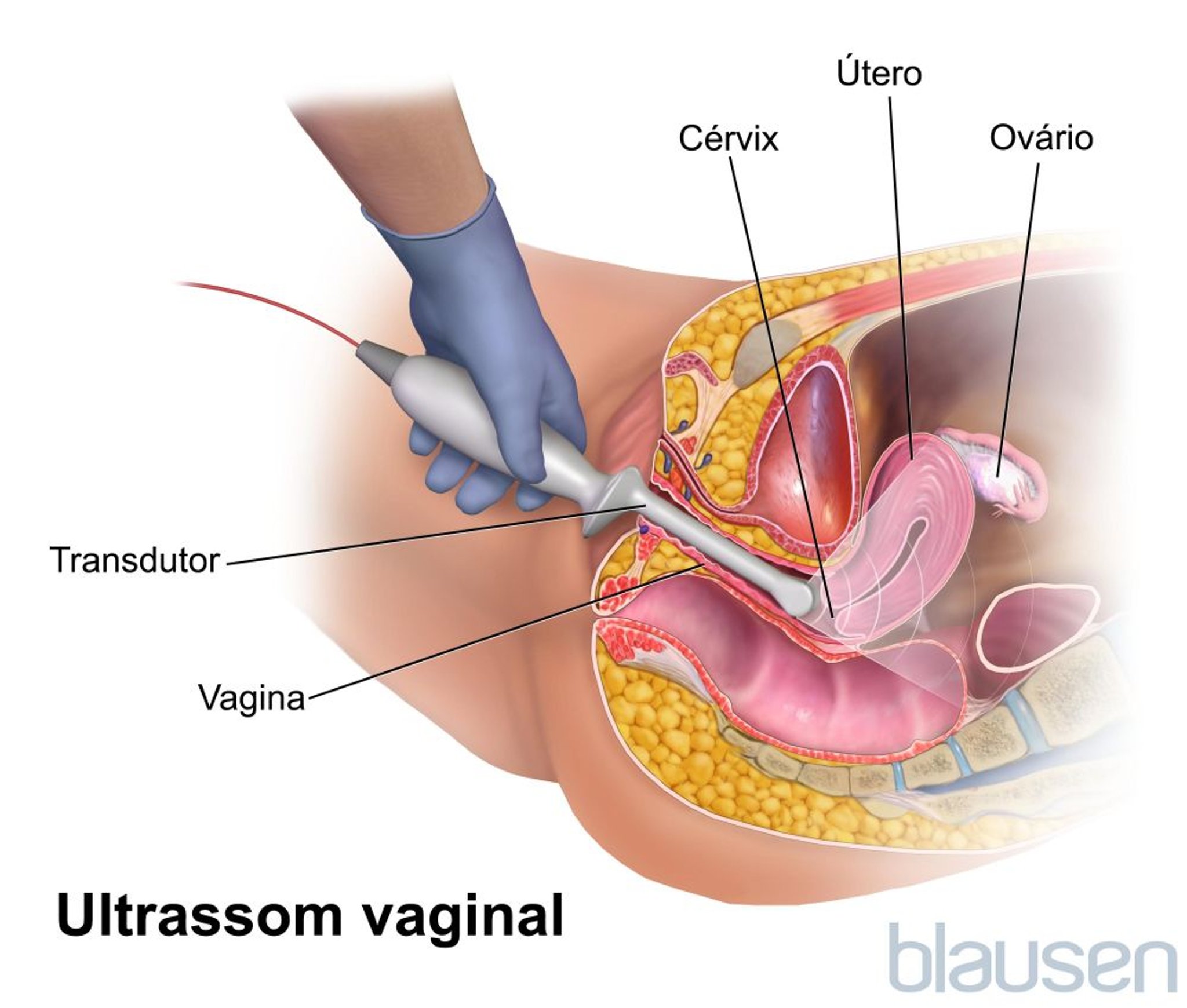 Ultrassonografia transvaginal
