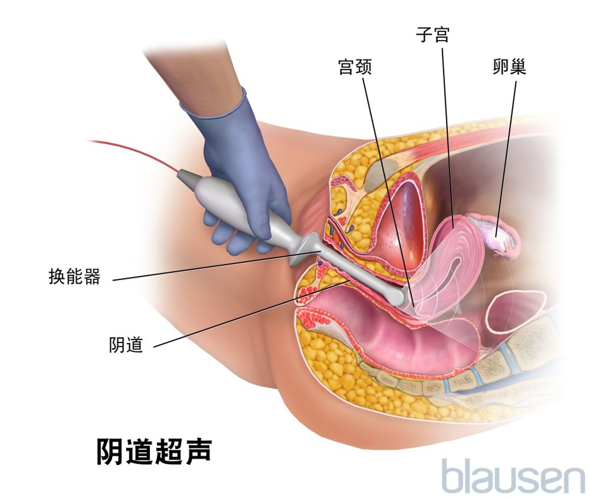 经阴道超声检查
