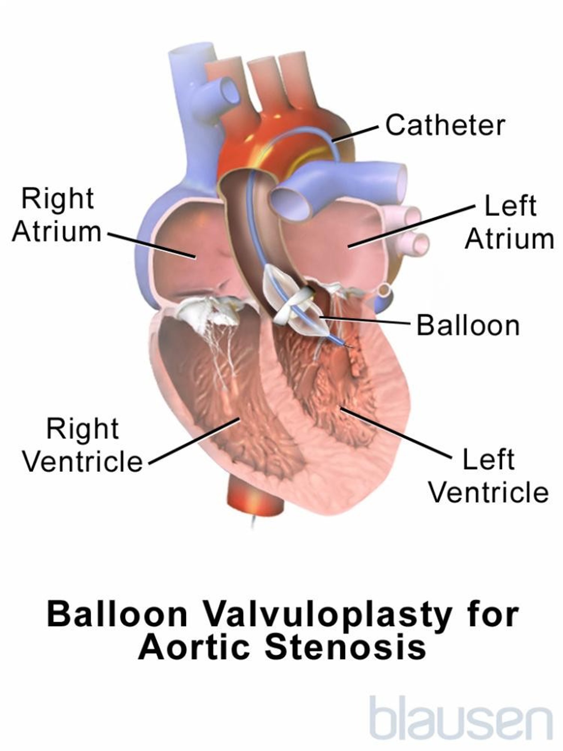 Balloon Valvuloplasty for Aortic Stenosis