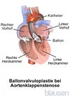 Ballonvalvuloplastie bei einer Aortenstenose