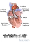 Valvuloplastia con balón para la estenosis aórtica