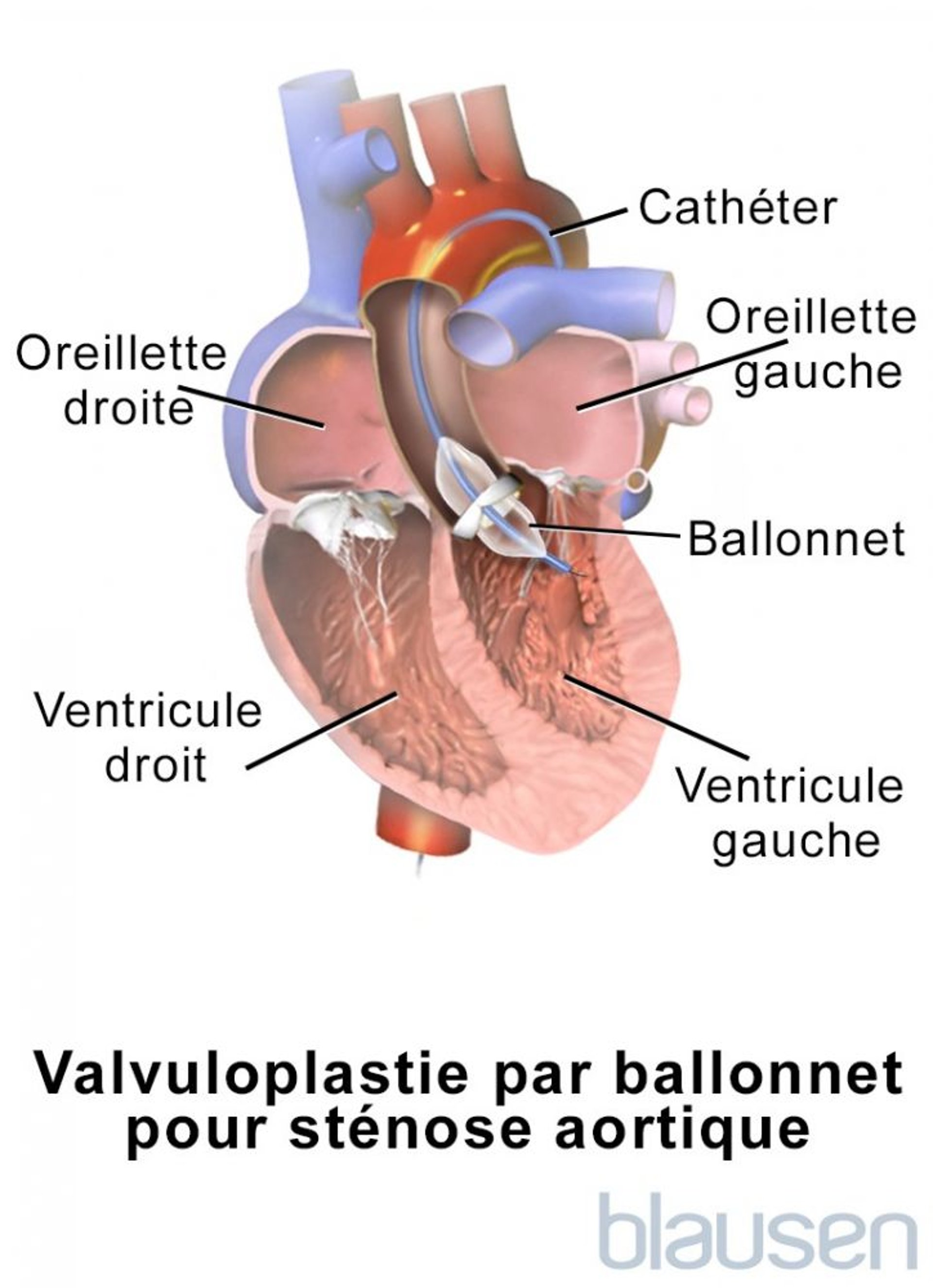 Valvuloplastie par ballonnet dans la sténose aortique