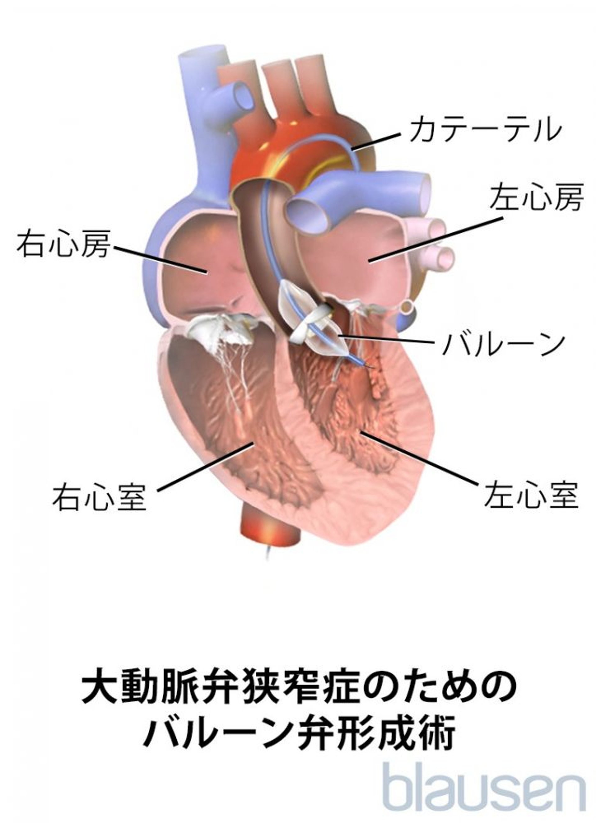 大動脈弁狭窄症に対するバルーン弁形成術