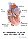 Valvuloplastia de balão para estenose aórtica