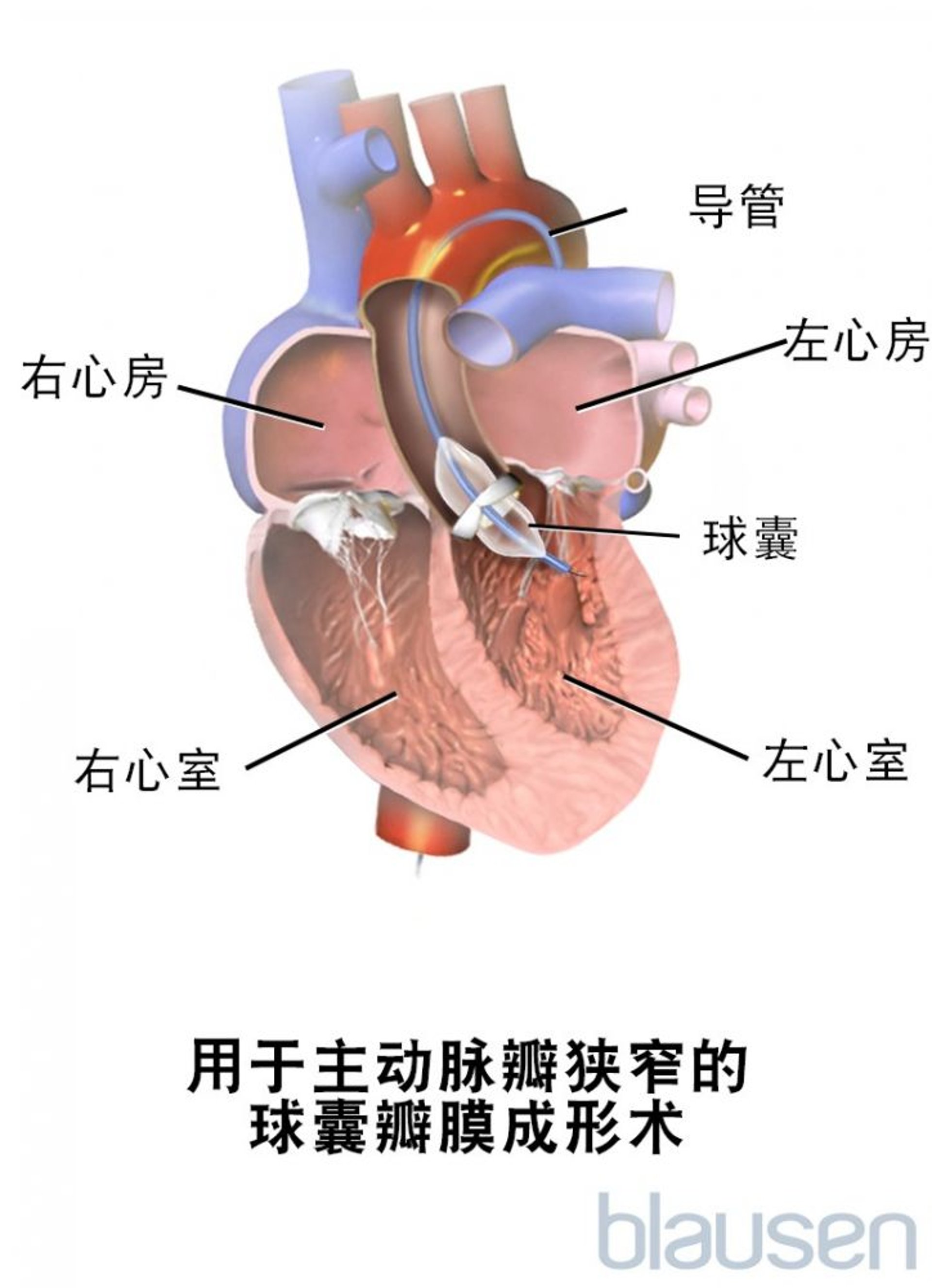 用于主动脉瓣狭窄的球囊瓣膜成形术