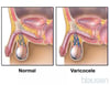 Varicocele