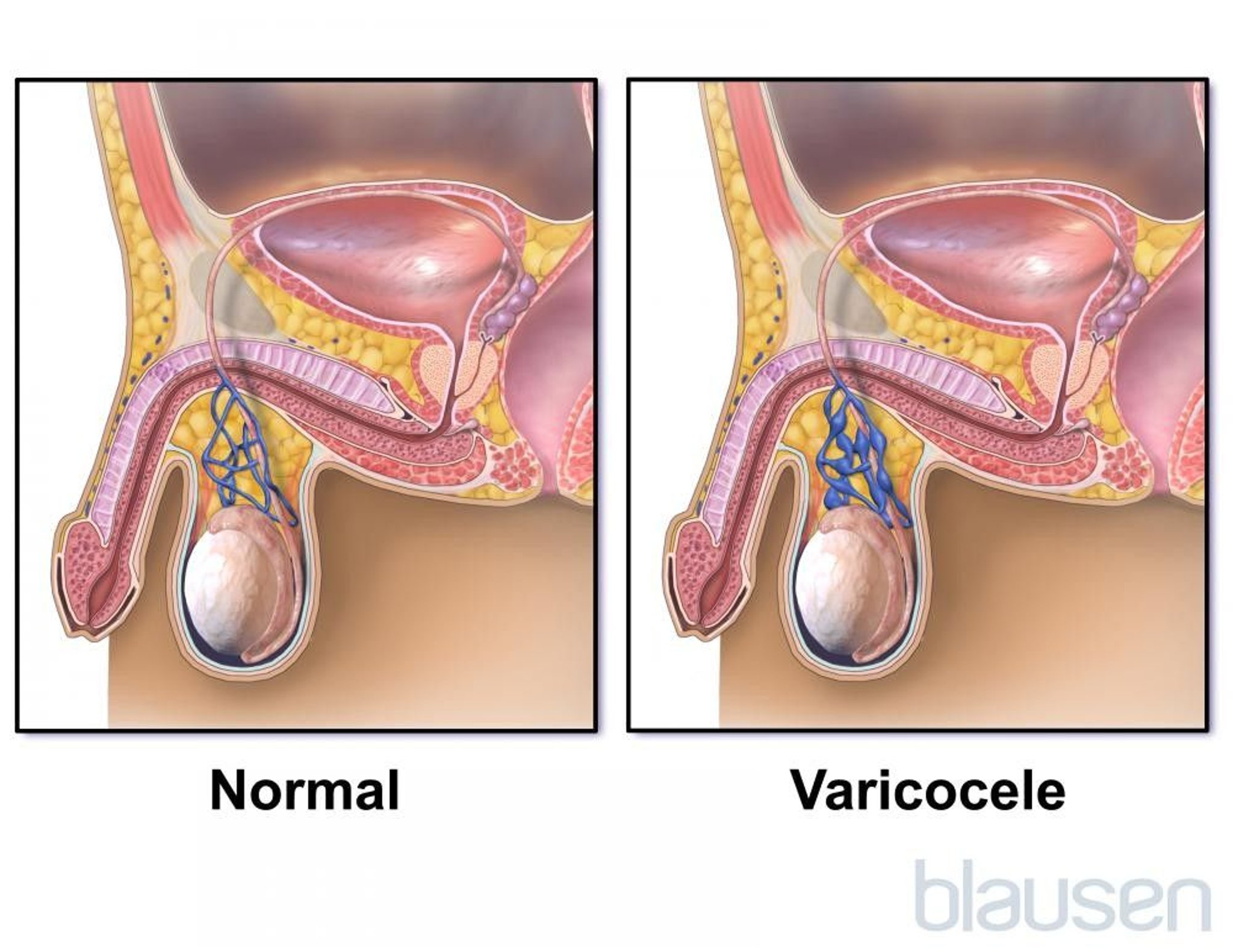 Varicocele