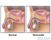 Varicocèle
