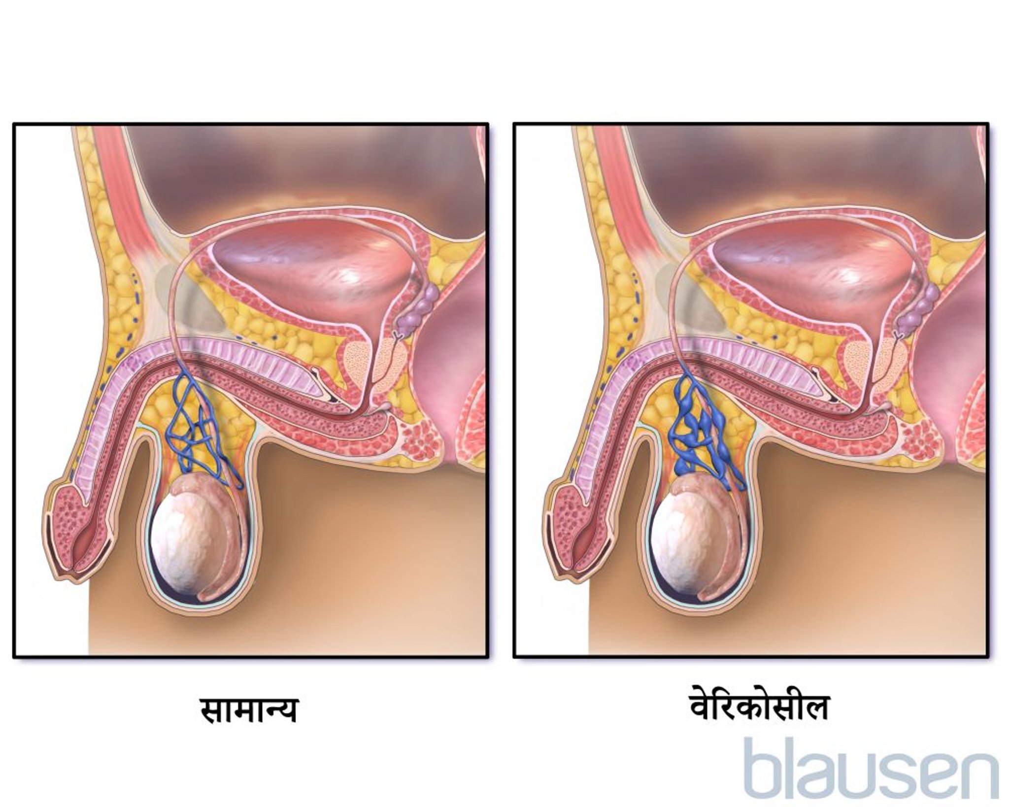 वेरिकोसील