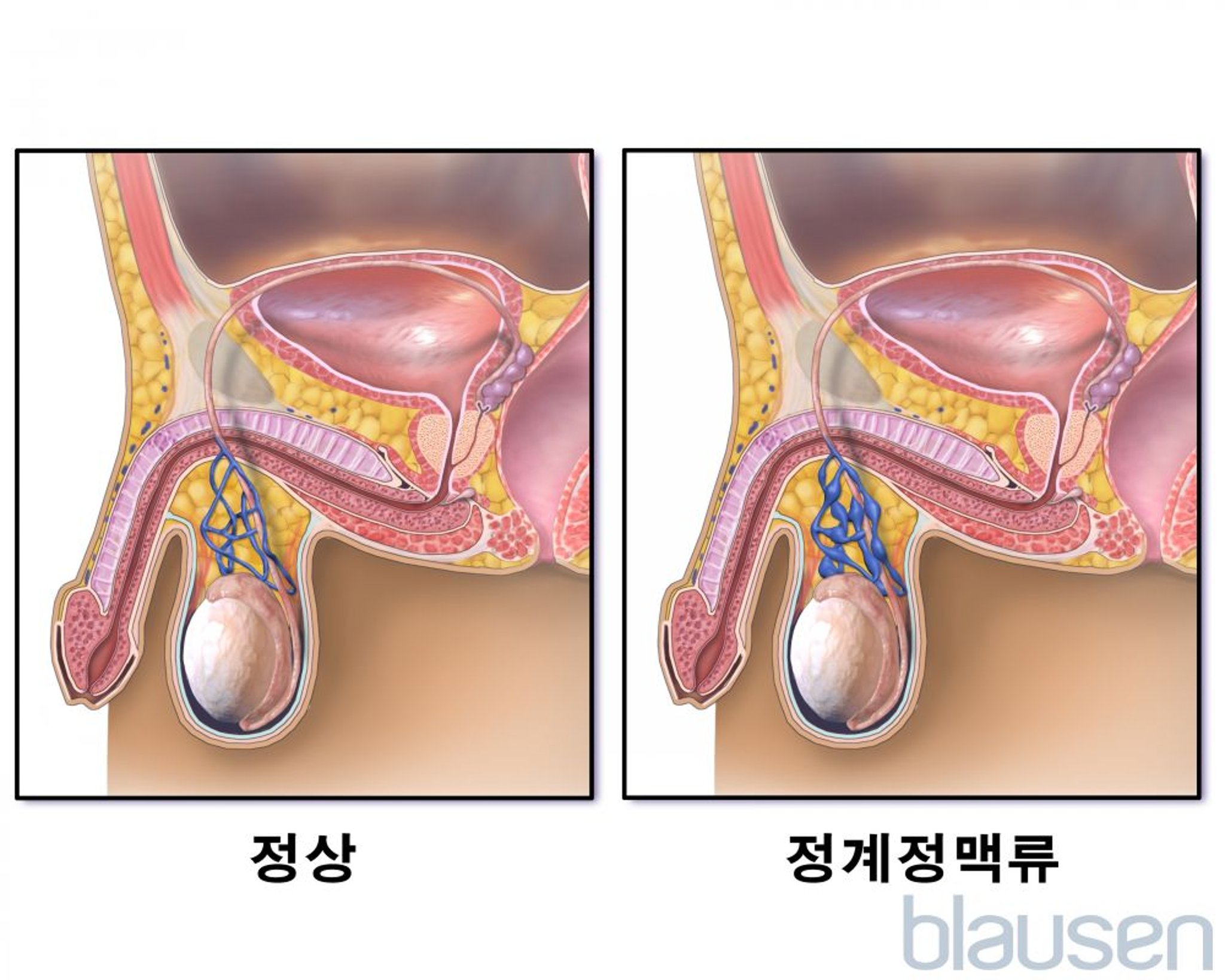 정계정맥류