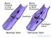 Blood Flow in Varicose Veins