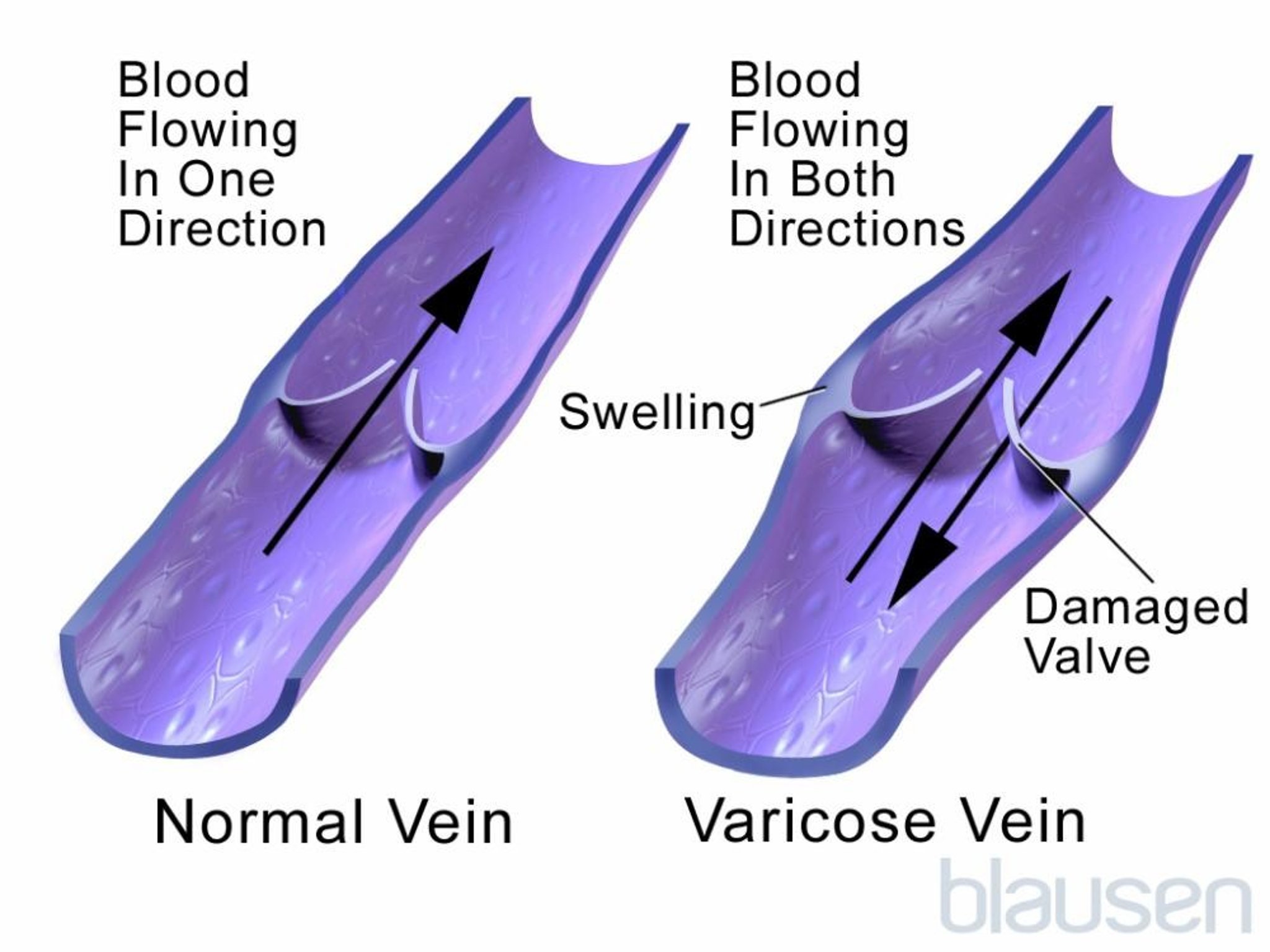 Blood Flow in Varicose Veins