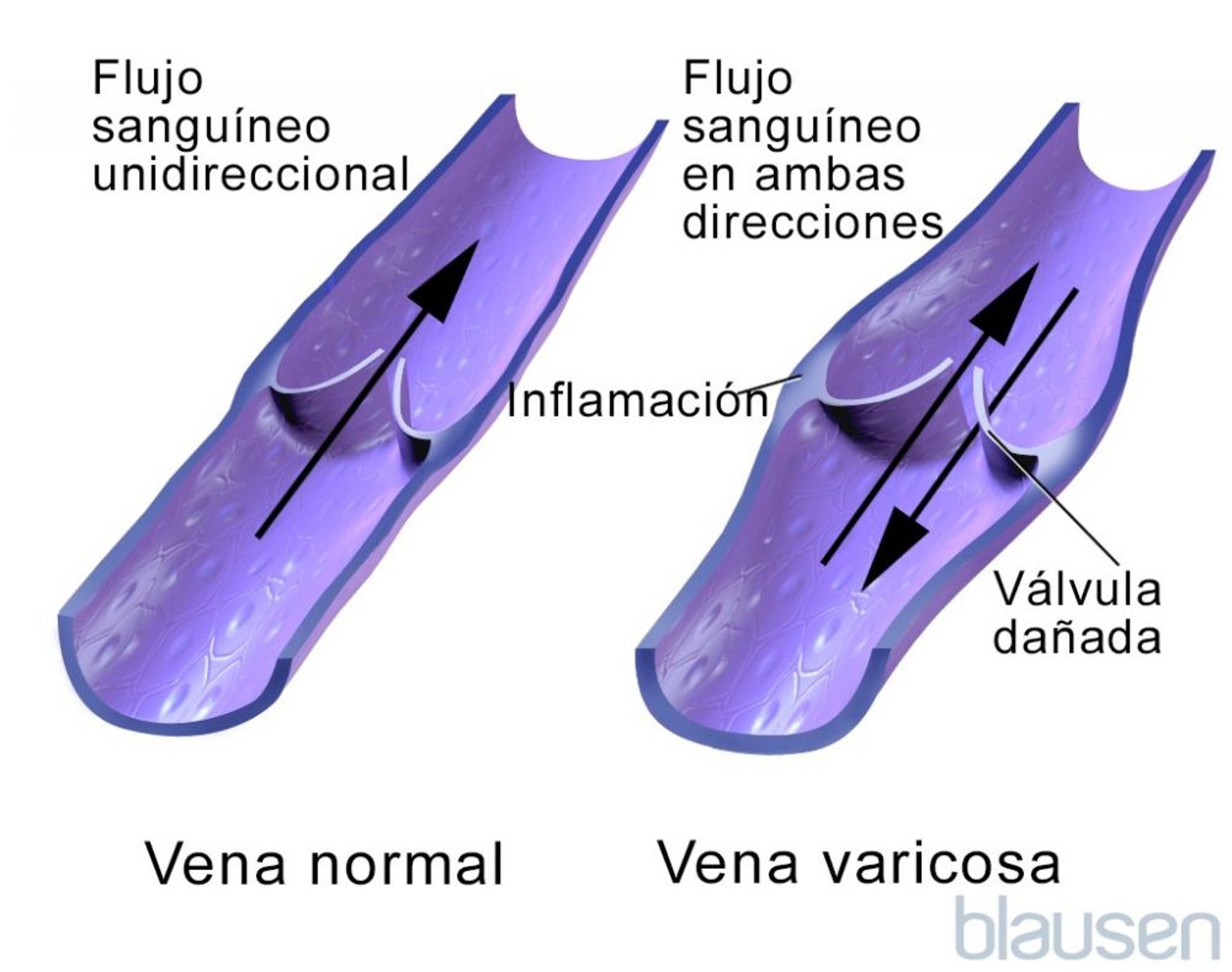 Flujo sanguíneo en las venas varicosas