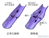 静脈瘤内の血流