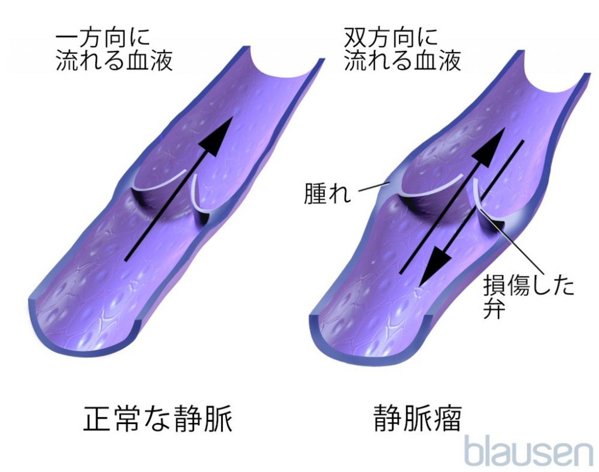 静脈瘤内の血流