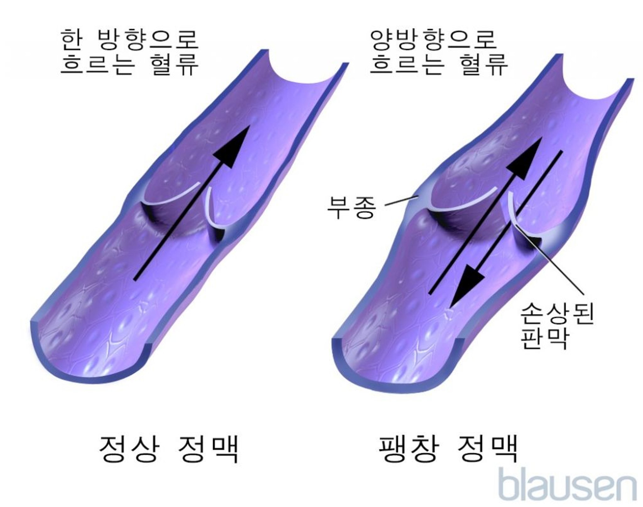 정맥류 정맥에서의 혈류