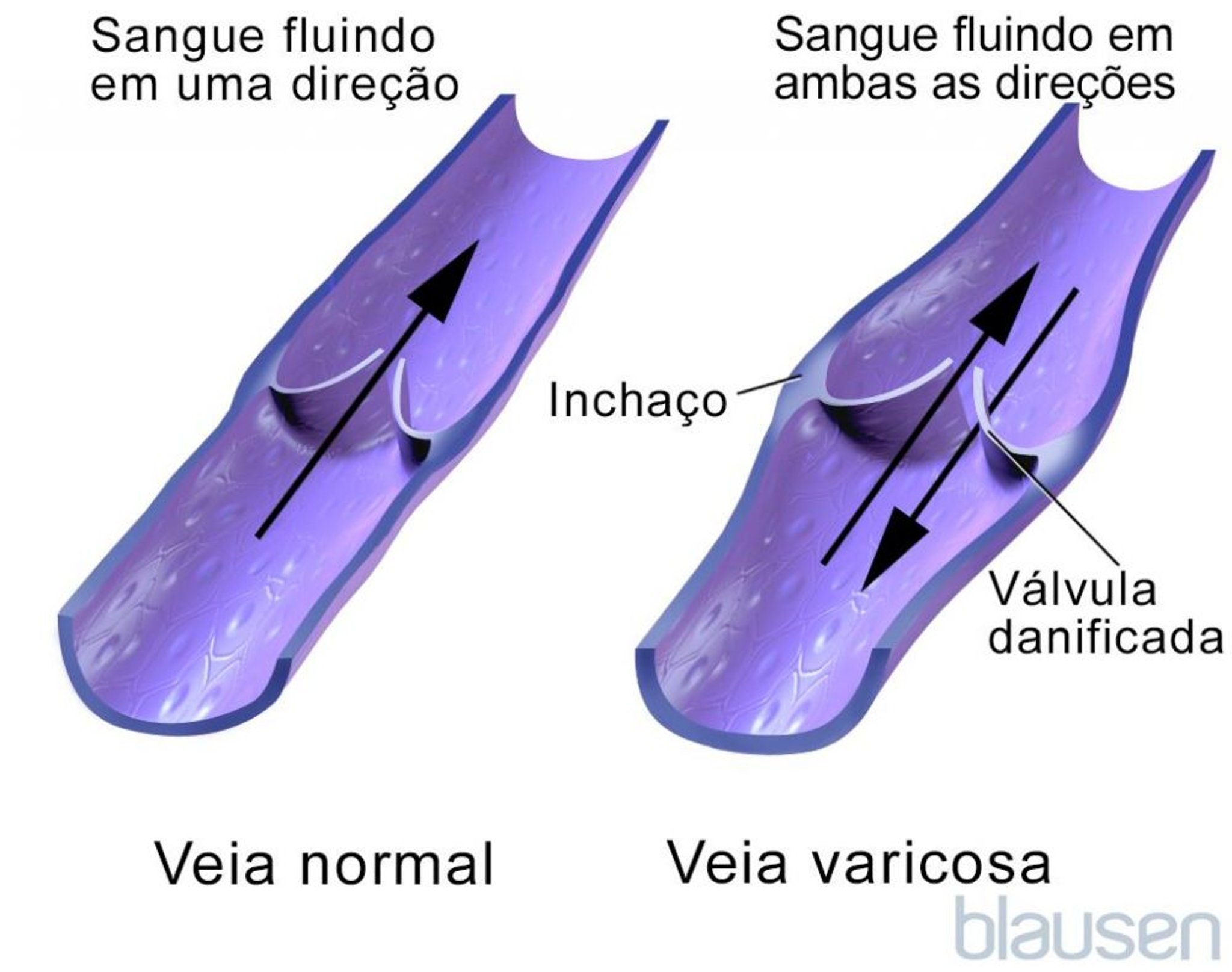Fluxo sanguíneo nas veias varicosas