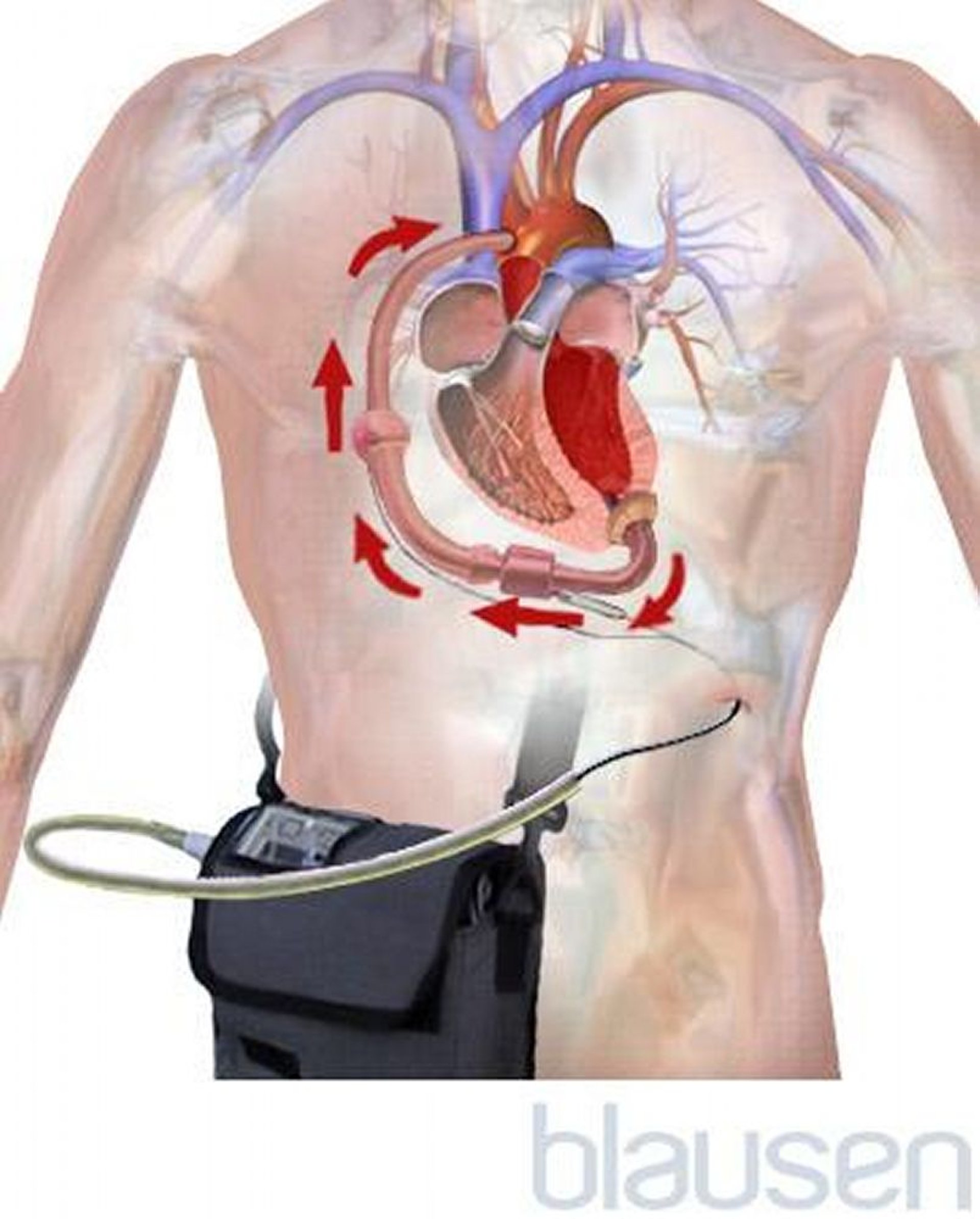 Dispositivo de asistencia ventricular