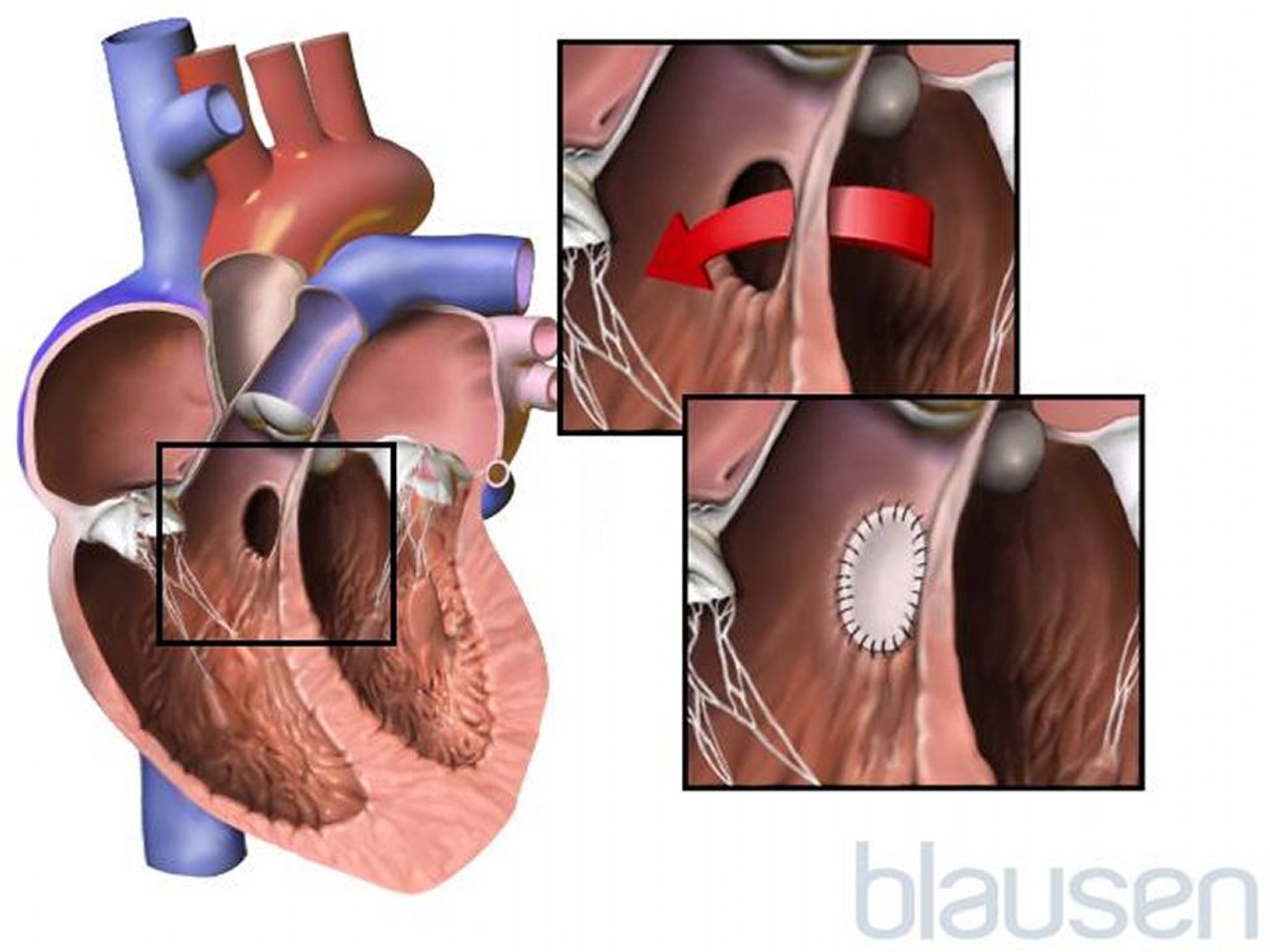 Retalho para correção de defeito septal ventricular