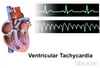 Ventricular Tachycardia