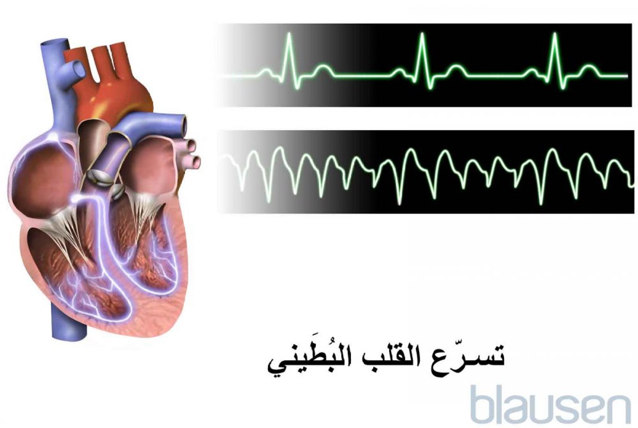 تسرع القلب البطيني