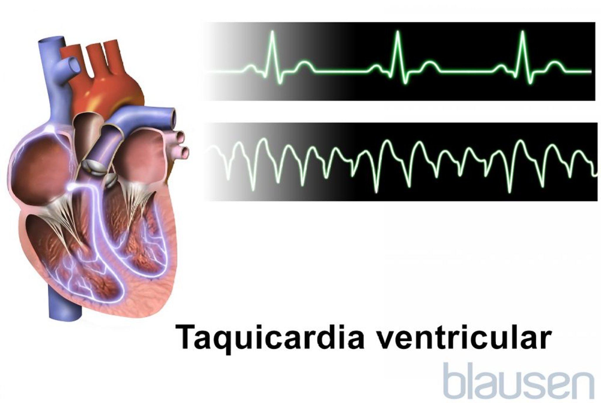 Taquicardia ventricular