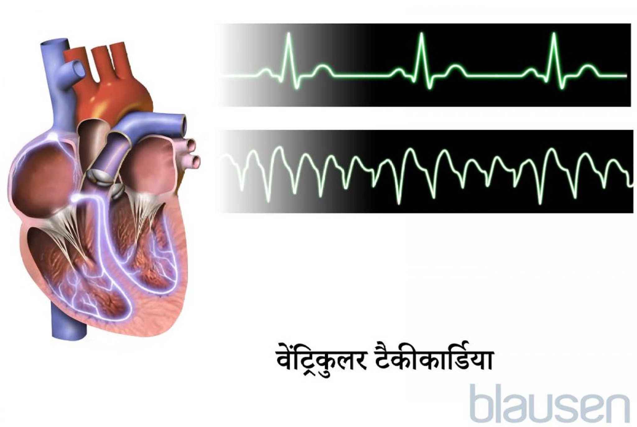 वेंट्रिकुलर टैकीकार्डिया