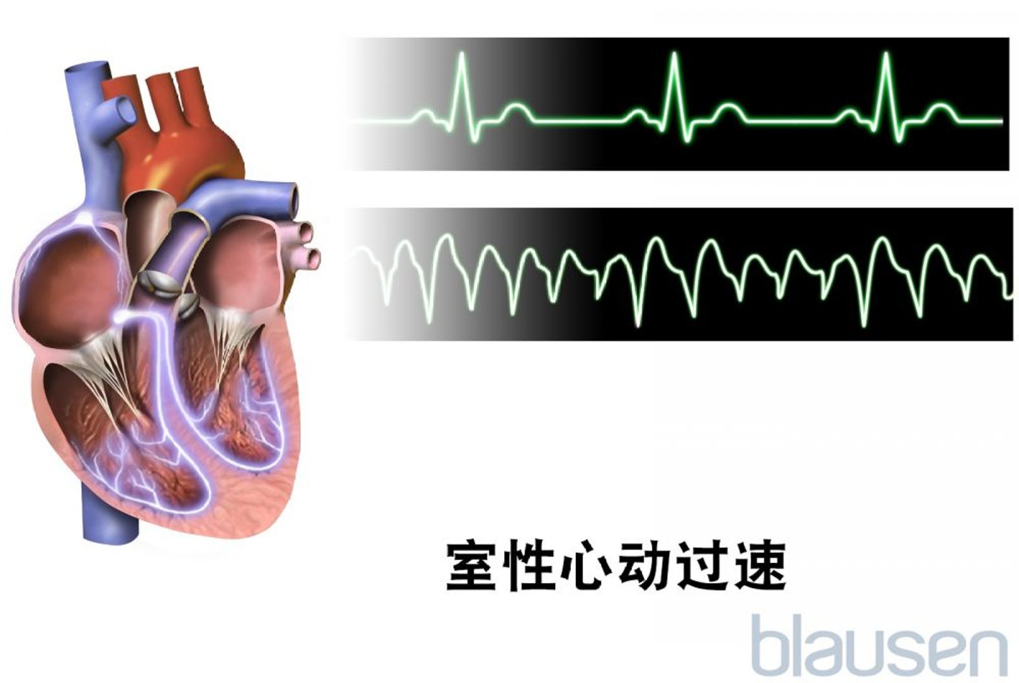 室性心动过速