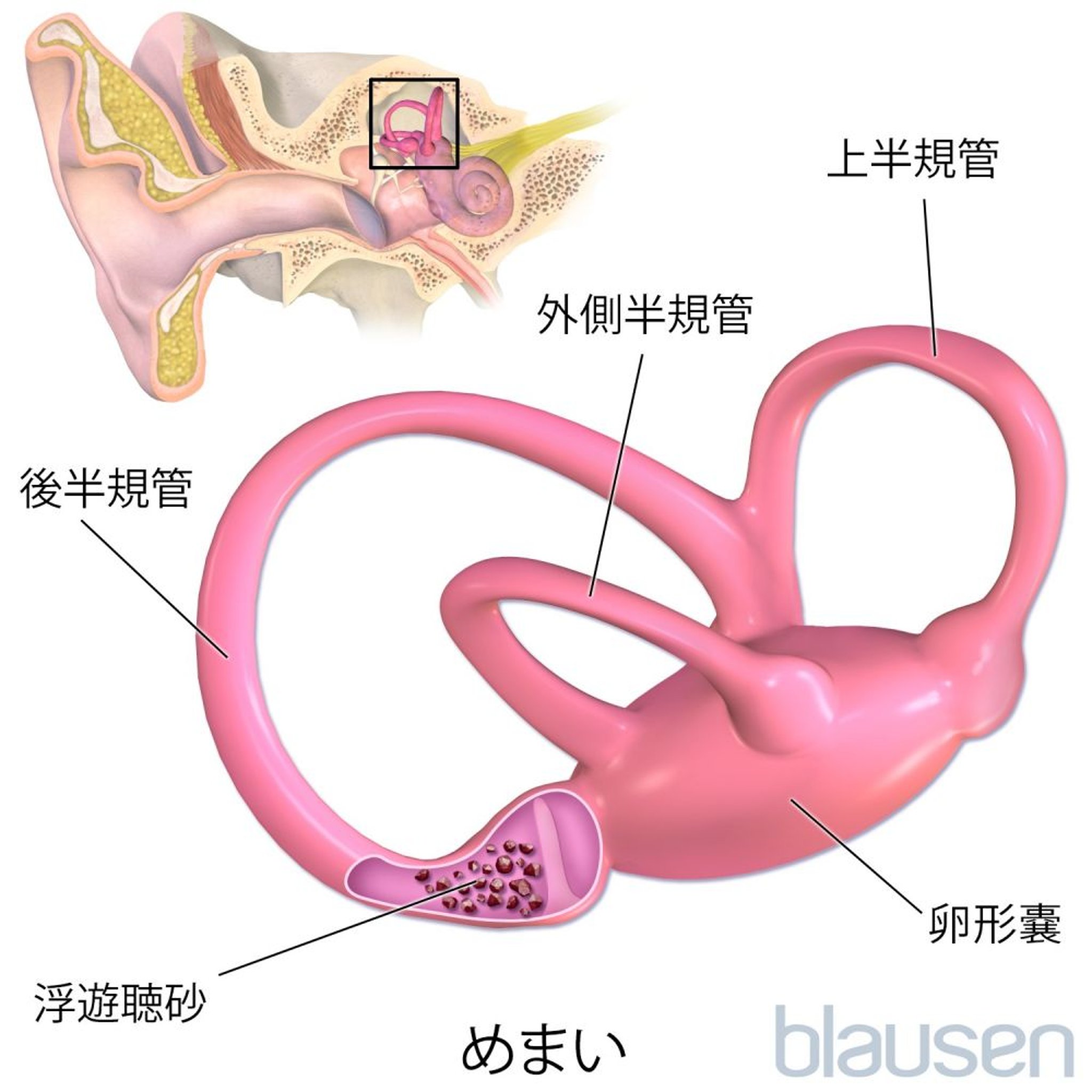 回転性めまい