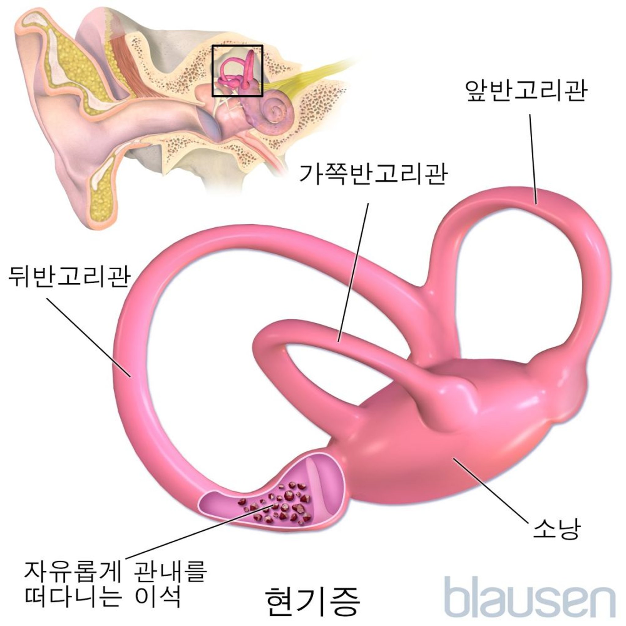 현기증